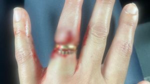 Moradora de Americana sofre tentativa de assalto e quase tem dedo arrancado por criminosos em Guarujá