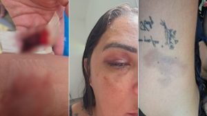 Prefeitura abre investigação após agressões contra paciente com endometriose