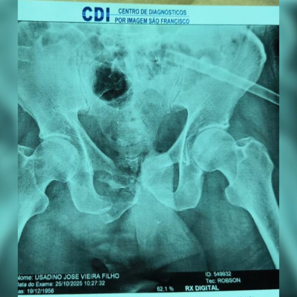 Raio-X de Usadino tirado em Bragança Paulista no dia 25 de Outubro mostra revertério na pélvis do idoso