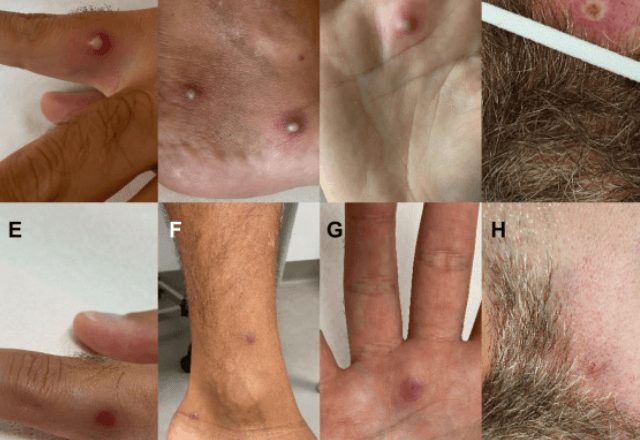 Lesões cutâneas características da Mpox em detalhe para identificação de sintomas clínicos e diagnóstico da doença.