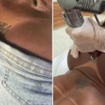 Tchau, mozão! Gracyanne Barbosa apaga tatuagem de Belo gravada no bumbum