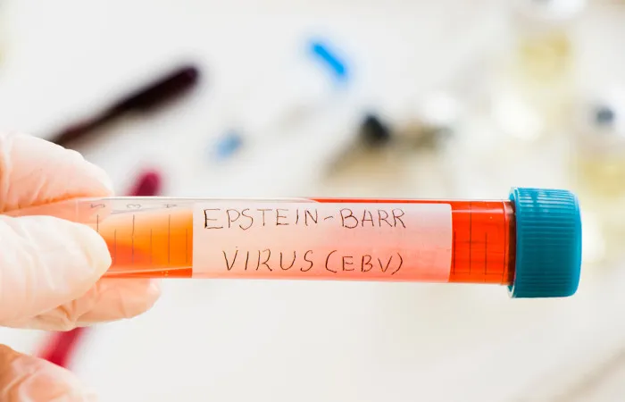 Close de rosto com inchaço nas pálpebras e lesões avermelhadas, sintomas característicos da mononucleose, a doença do beijo.