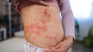 surto de sarampo em campinas