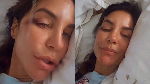 Ivete Sangalo passa mal e aparece com machucados no rosto